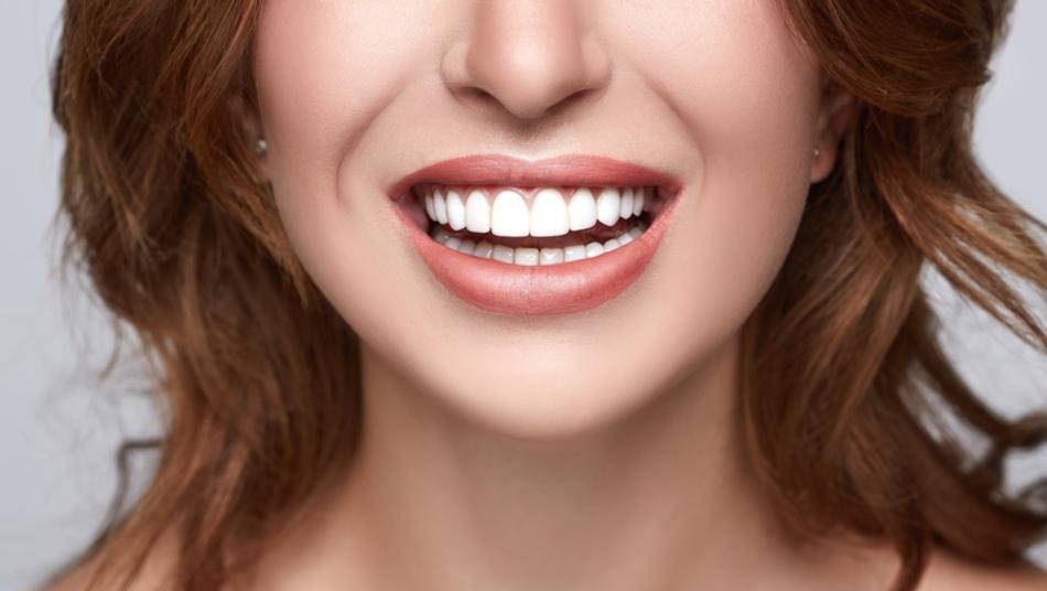 fatete dentare Timisoara, dinti din ceramica emax