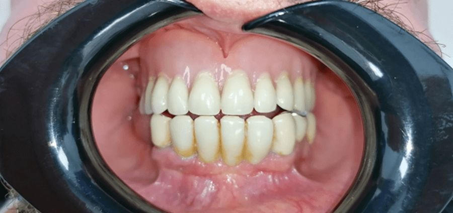 reabilitare dentara Timisoara, implanturi dentare Fast and Fixed Timisoara