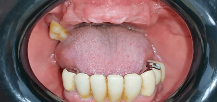 reabilitare dentara Timisoara, implanturi dentare Fast and Fixed Timisoara