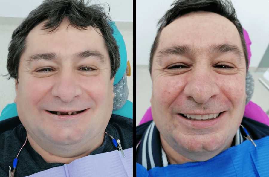 reabilitare dentara Timisoara, implanturi dentare Fast and Fixed Timisoara