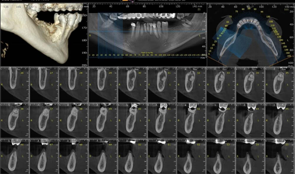 CBCT Timisoara,, radiografie dentara, tomografie dentara computerizata