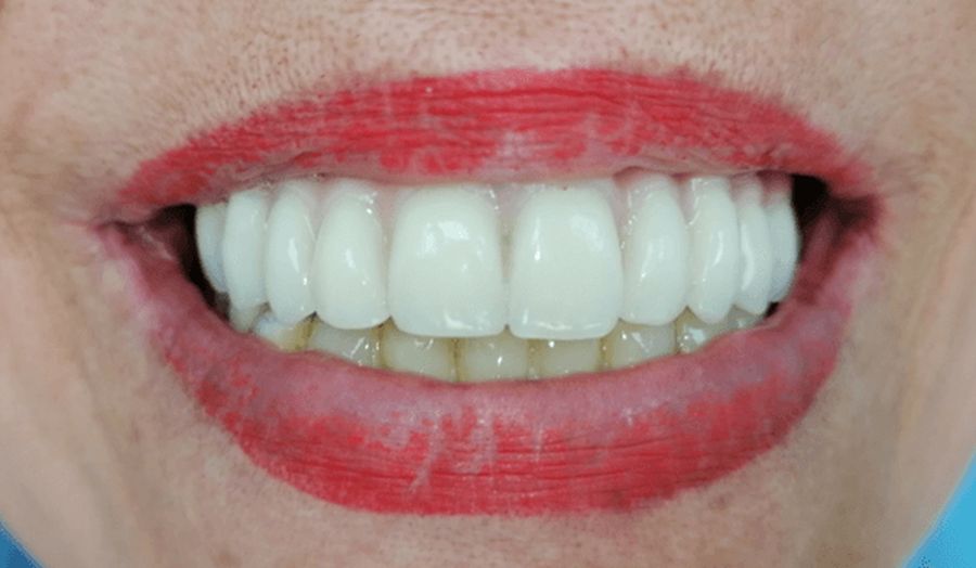 reabilitare dentara Timisoara, implanturi dentare Fast and Fixed Timisoara