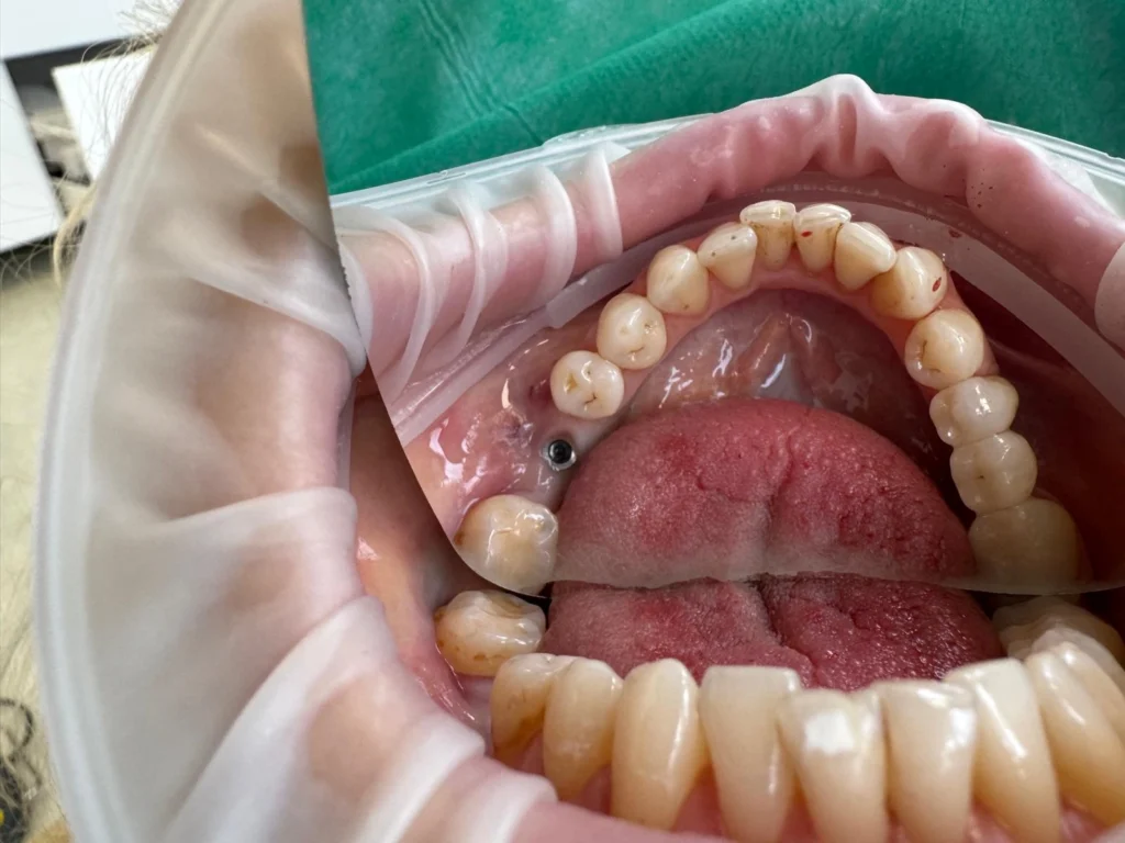 poza pivot implant dentar