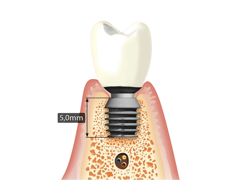 implant dentar