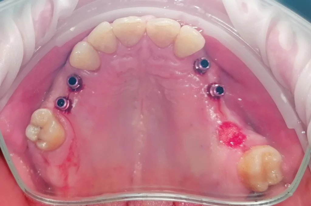 simptome respingere implant dentar