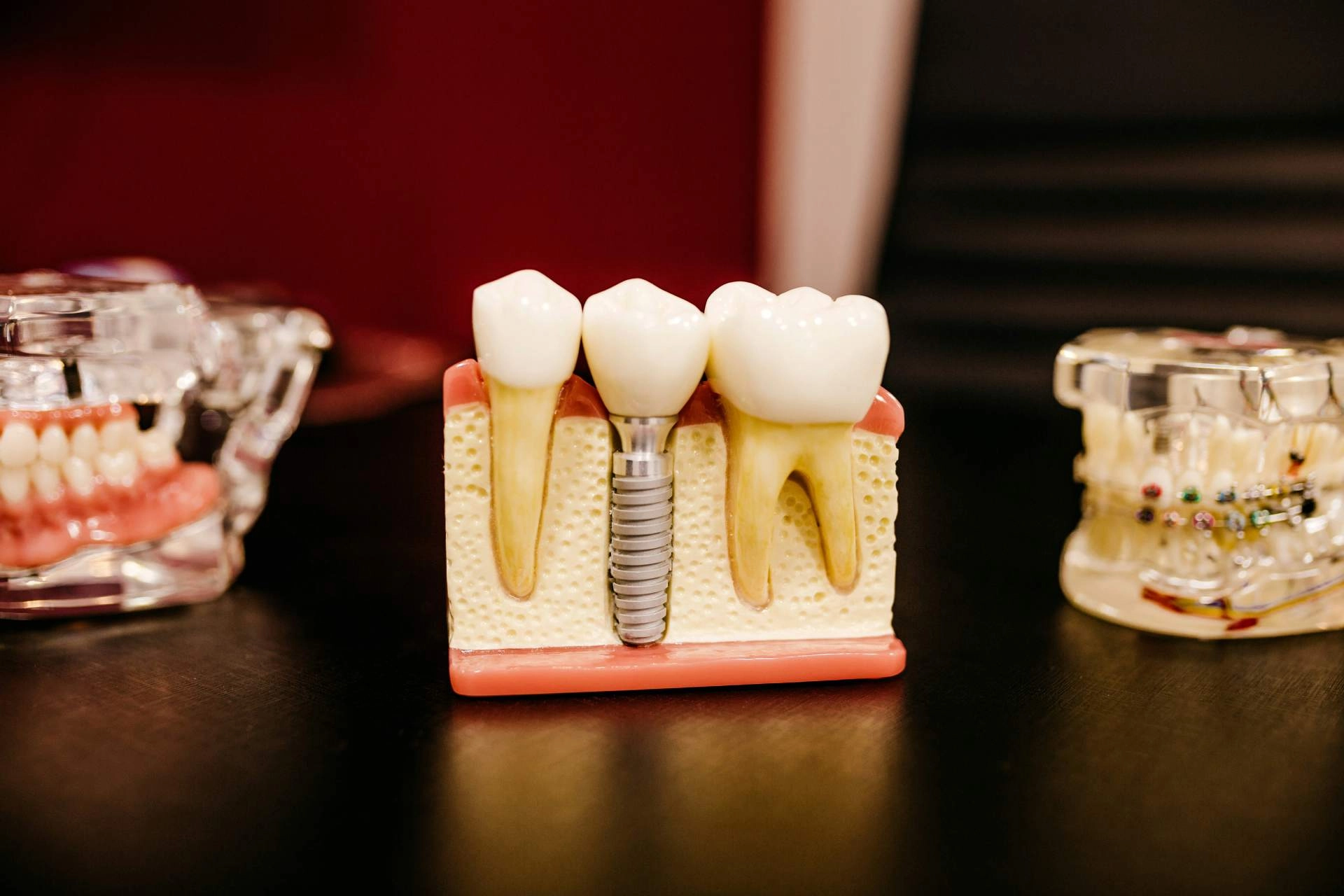 implant recuperare