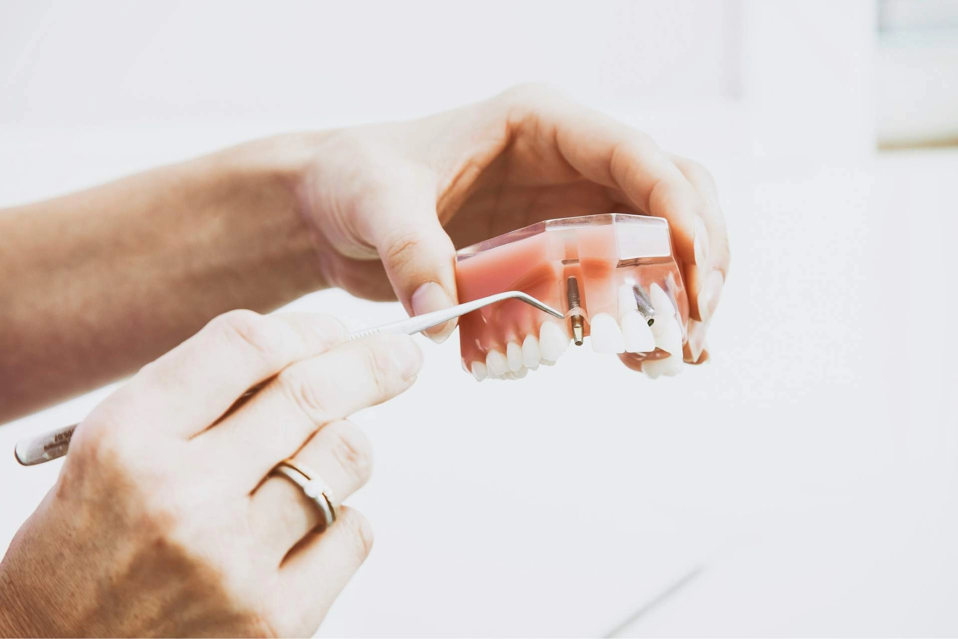 implant sau punte dentara
