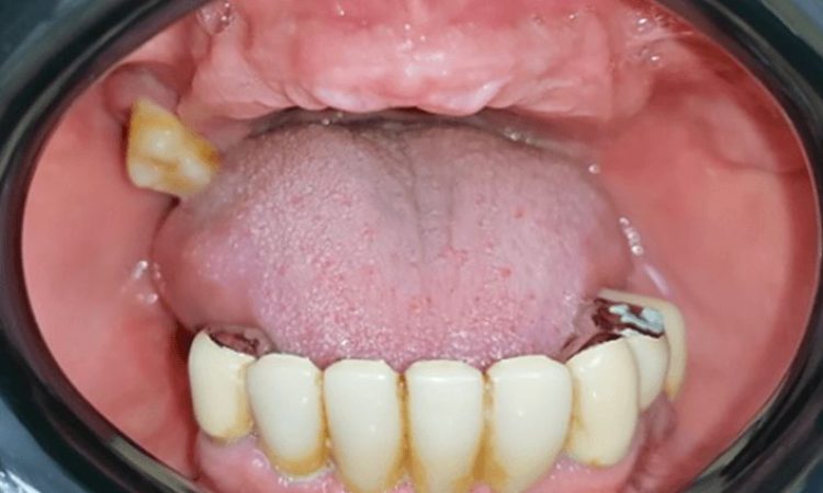 reabilitare dentara Timisoara, implanturi dentare Fast and Fixed Timisoara